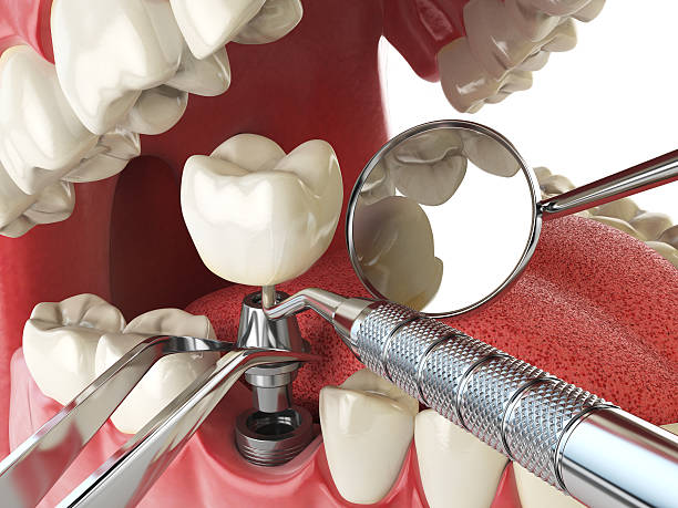 Best Emergency Dentist for Lost Fillings or Crowns in Homewood, IL